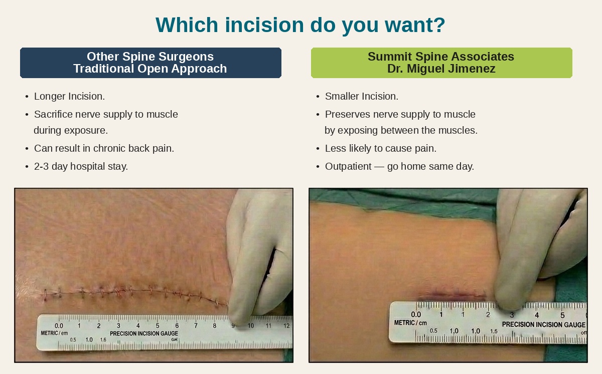 Comparison of traditional open spine surgery incision versus Dr. Jimenez's minimally invasive incision — smaller, less scarring, faster recovery